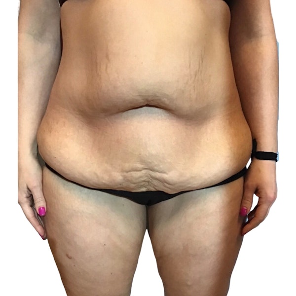 Tummy Tuck