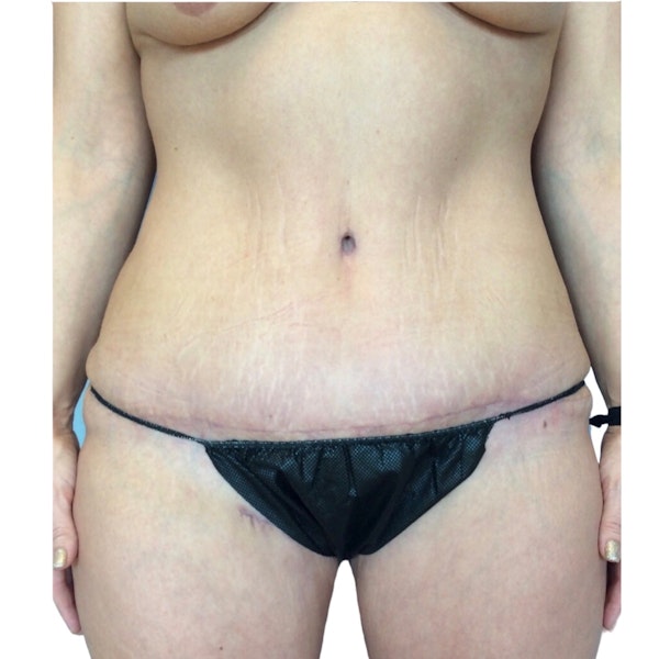 Tummy Tuck