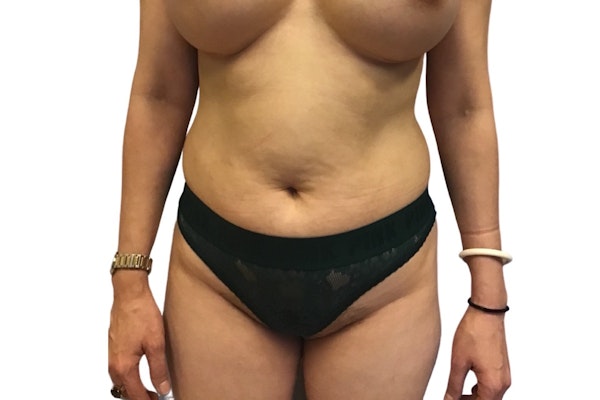 Tummy Tuck