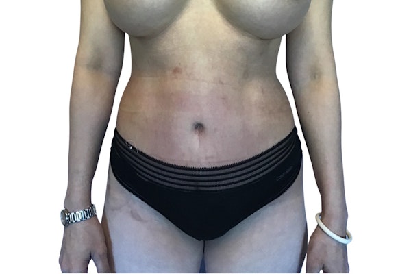 Tummy Tuck
