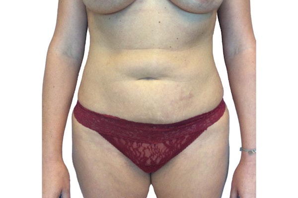 Tummy Tuck