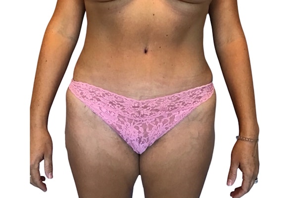 Tummy Tuck