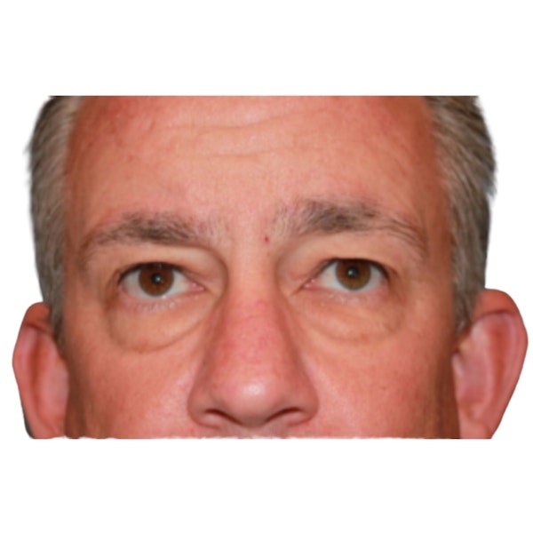 Eyelid Surgery Before