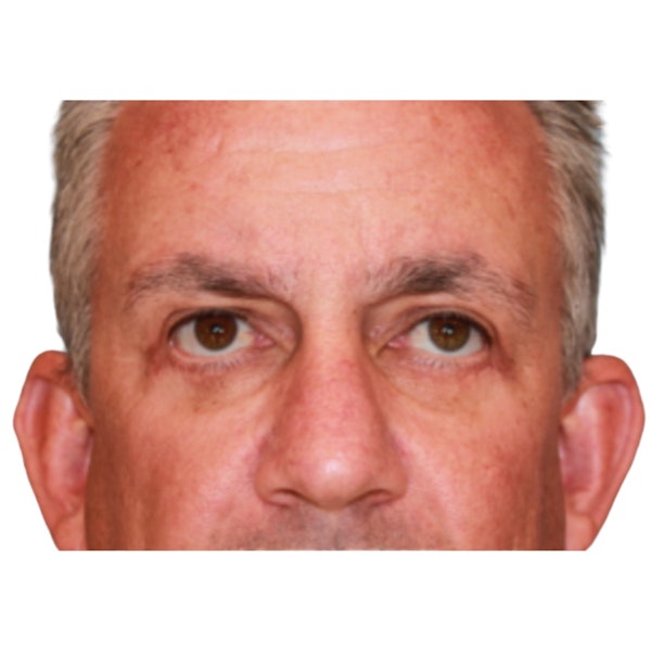 Eyelid Surgery After