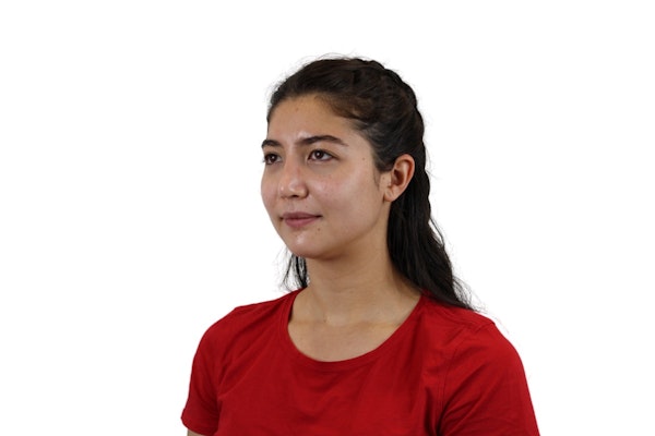 Rhinoplasty results in Scottsdale