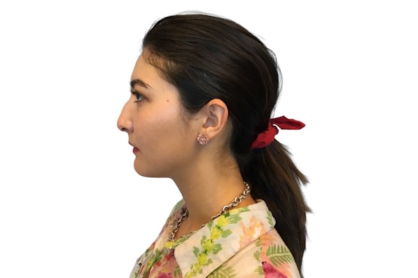 Rhinoplasty results in Scottsdale