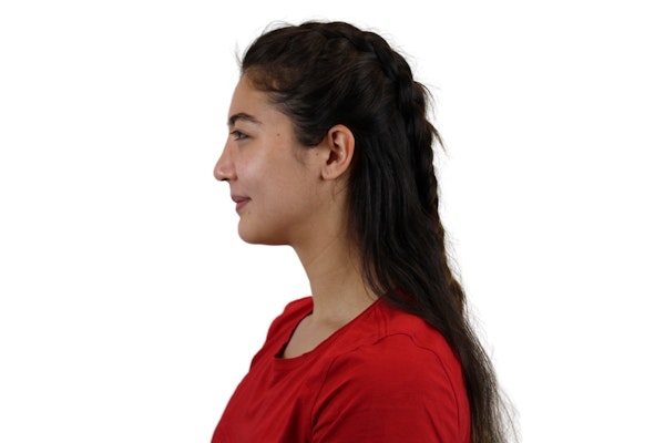 Rhinoplasty results in Scottsdale