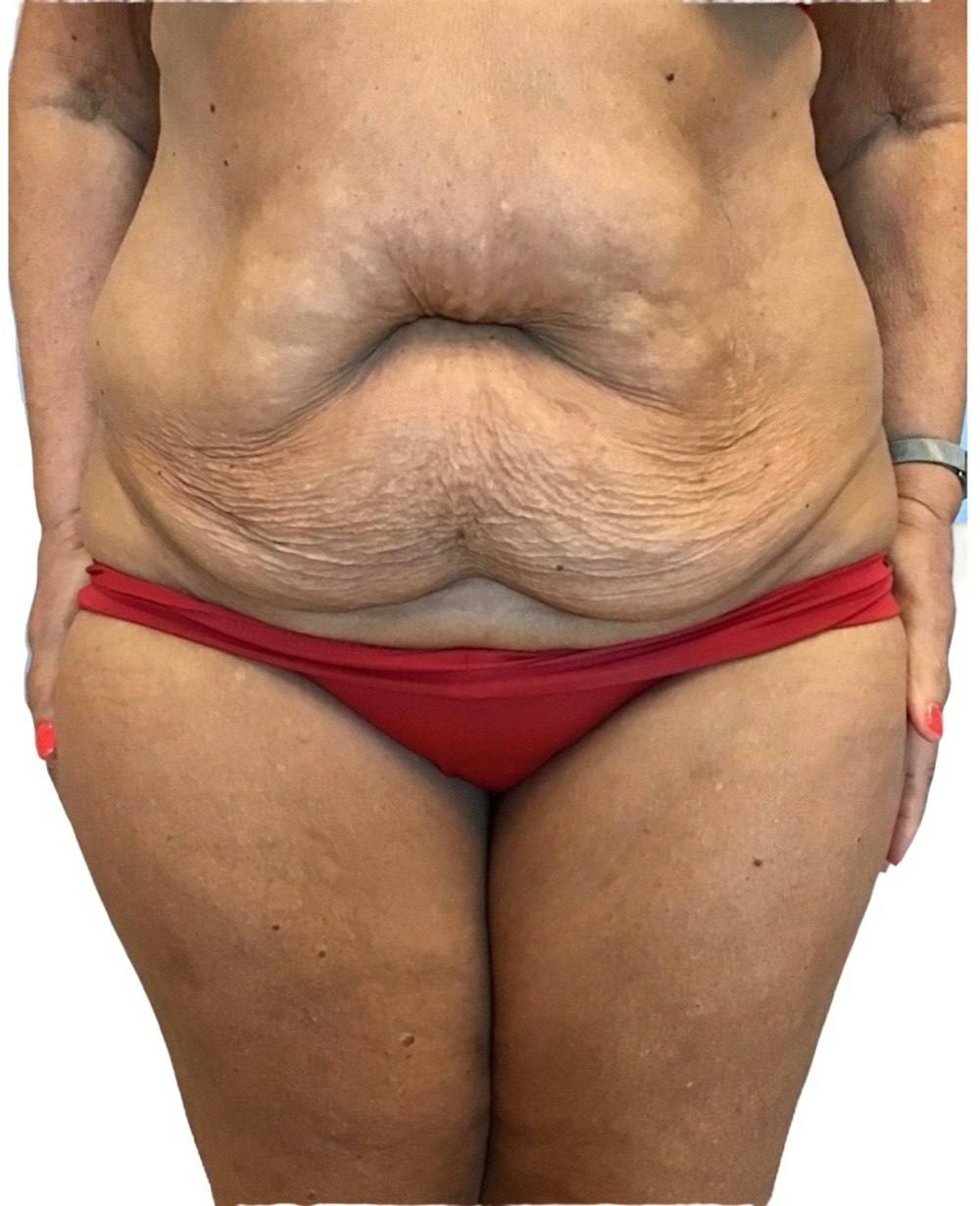 Abdominoplasty Before & After Gallery - Patient 13948275 - Image 1