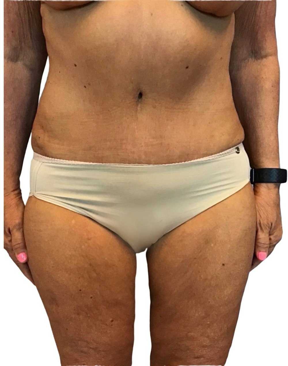 Abdominoplasty Before & After Gallery - Patient 13948275 - Image 2