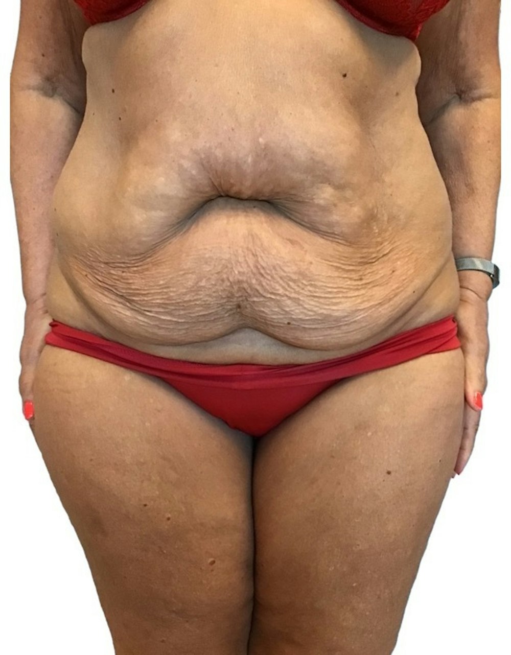 Abdominoplasty Before & After Gallery - Patient 13948275 - Image 3