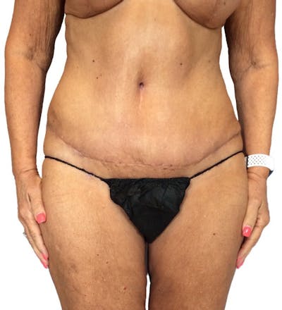 Abdominoplasty Before & After Gallery - Patient 13948275 - Image 4