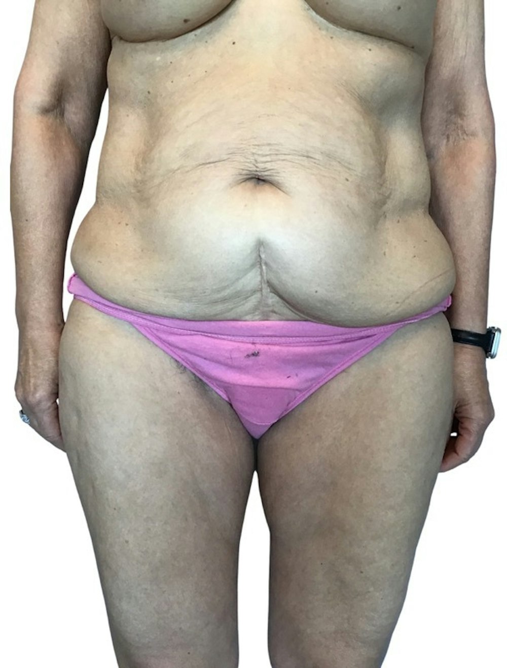 Abdominoplasty Before & After Gallery - Patient 13948276 - Image 1