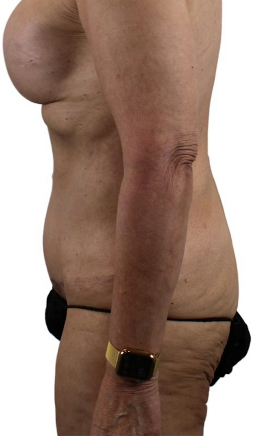 Abdominoplasty Before & After Gallery - Patient 13948276 - Image 4