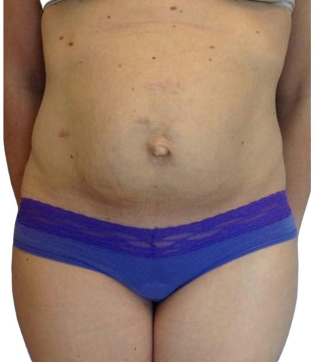 Abdominoplasty Before & After Gallery - Patient 13948277 - Image 1