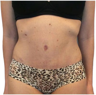 Abdominoplasty Before & After Gallery - Patient 13948277 - Image 2