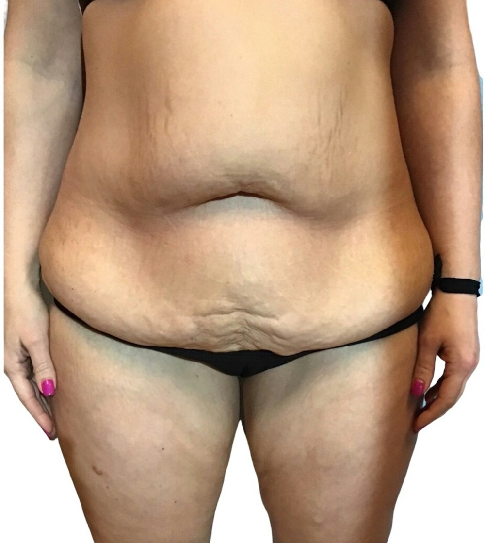 Abdominoplasty Before & After Gallery - Patient 13948278 - Image 1