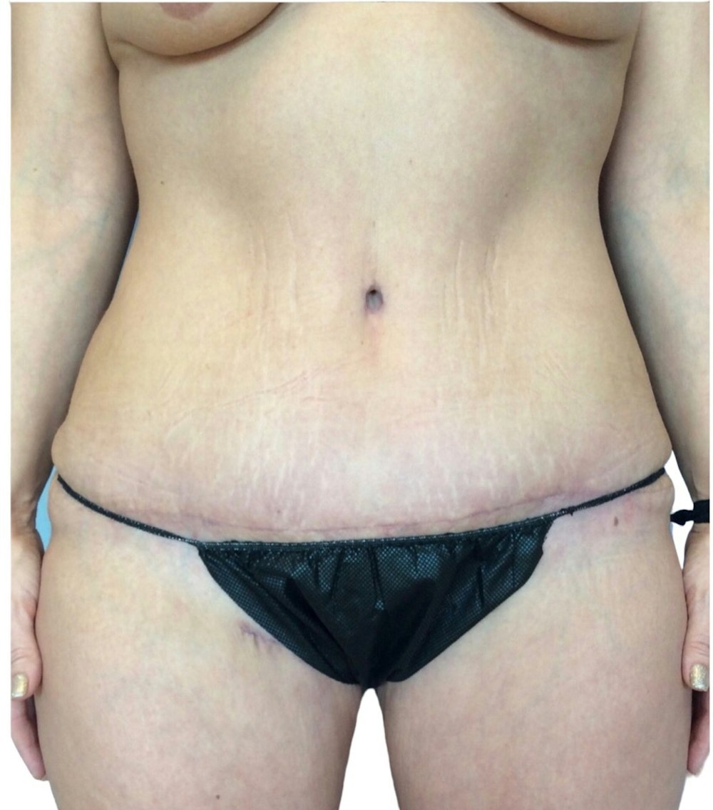 Abdominoplasty Before & After Gallery - Patient 13948278 - Image 2