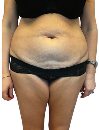 Abdominoplasty Before & After Gallery - Patient 13948279 - Image 1