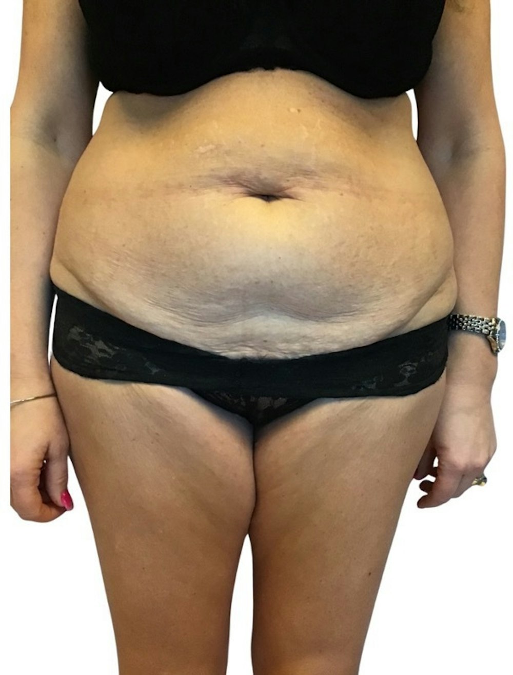 Abdominoplasty Before & After Gallery - Patient 13948279 - Image 1