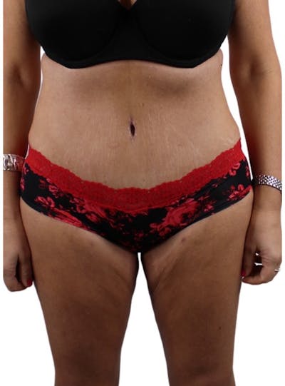 Abdominoplasty Before & After Gallery - Patient 13948279 - Image 2