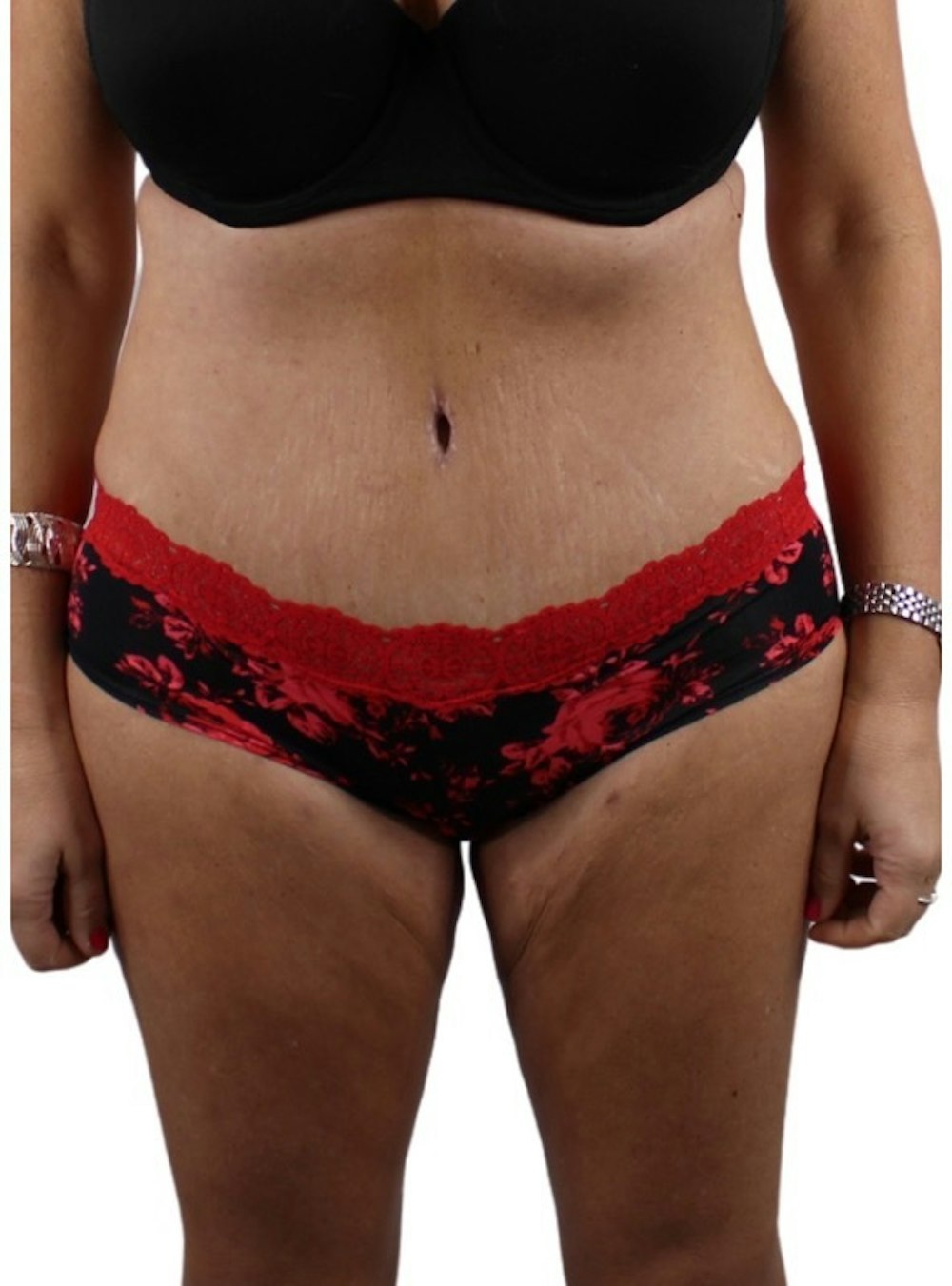 Abdominoplasty Before & After Gallery - Patient 13948279 - Image 2