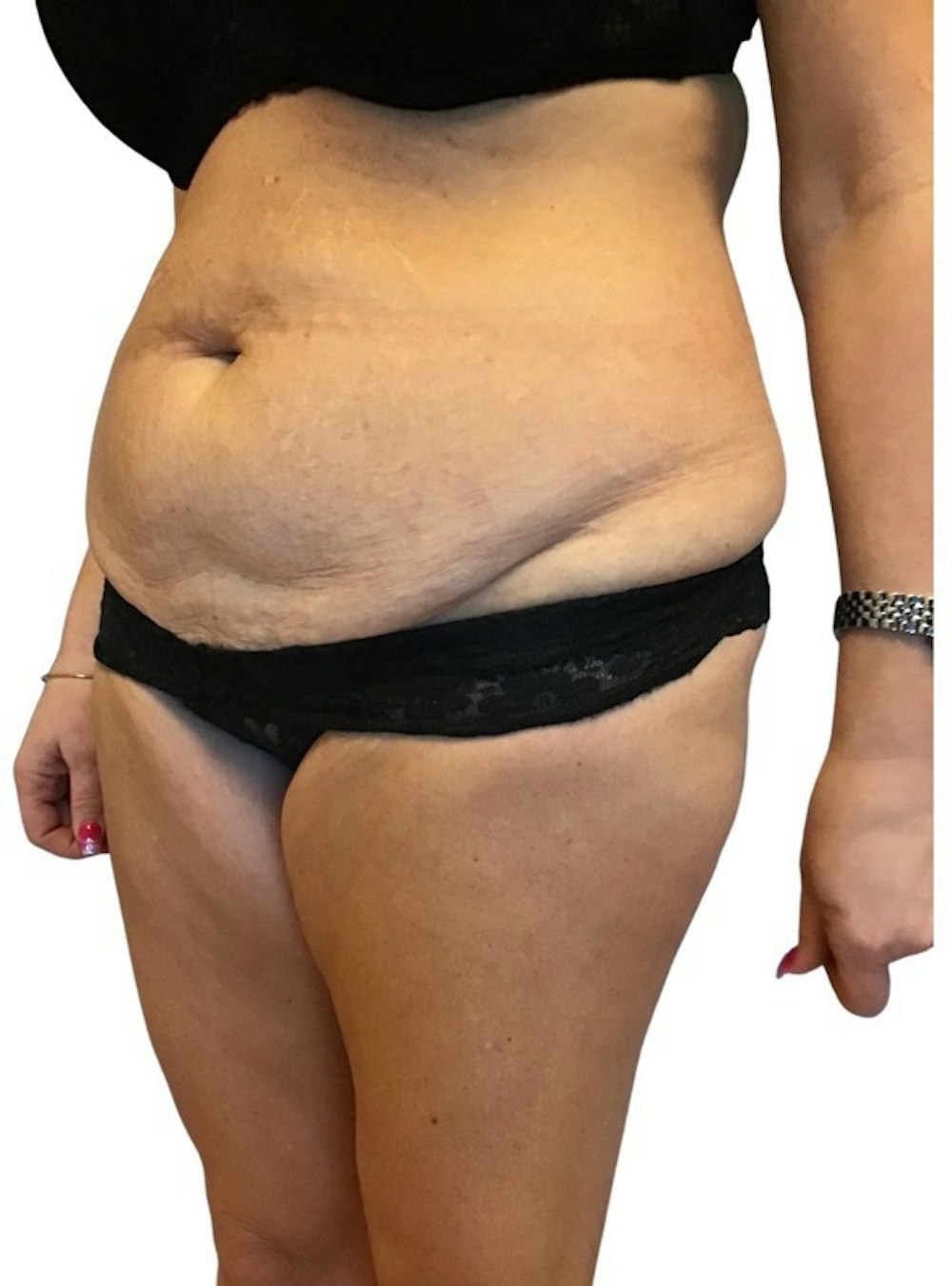 Abdominoplasty Before & After Gallery - Patient 13948279 - Image 3