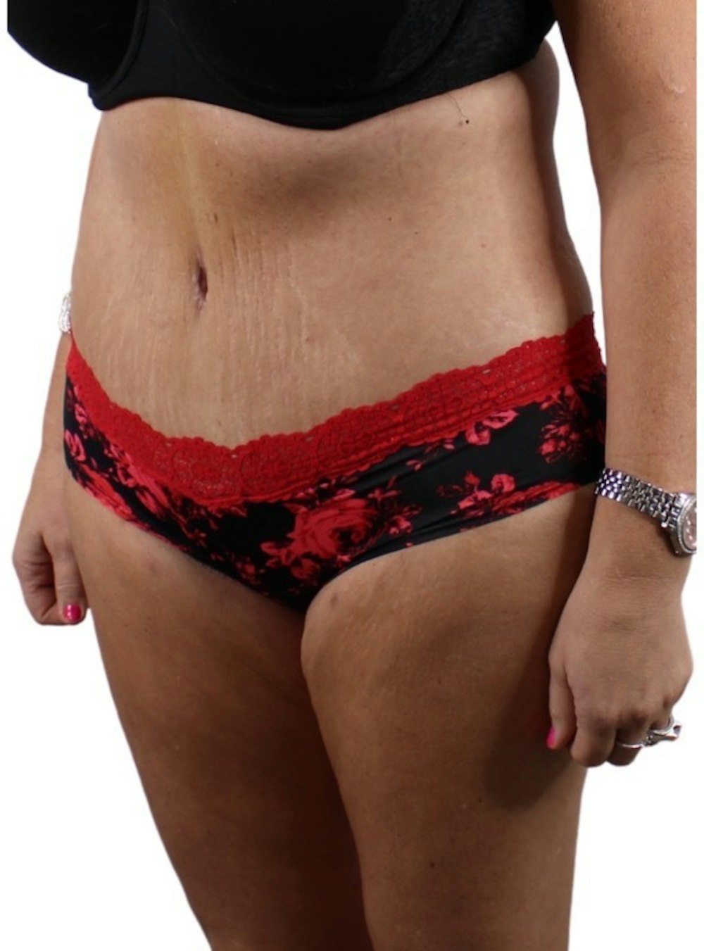 Abdominoplasty Before & After Gallery - Patient 13948279 - Image 4