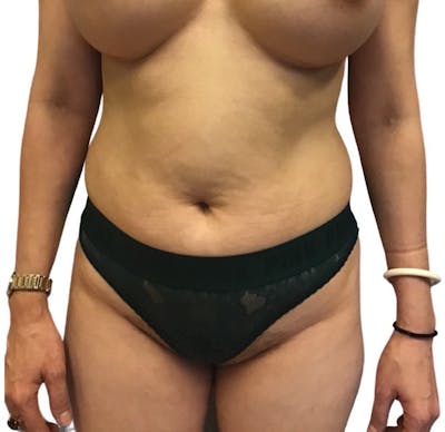 Abdominoplasty Before & After Gallery - Patient 13948280 - Image 1
