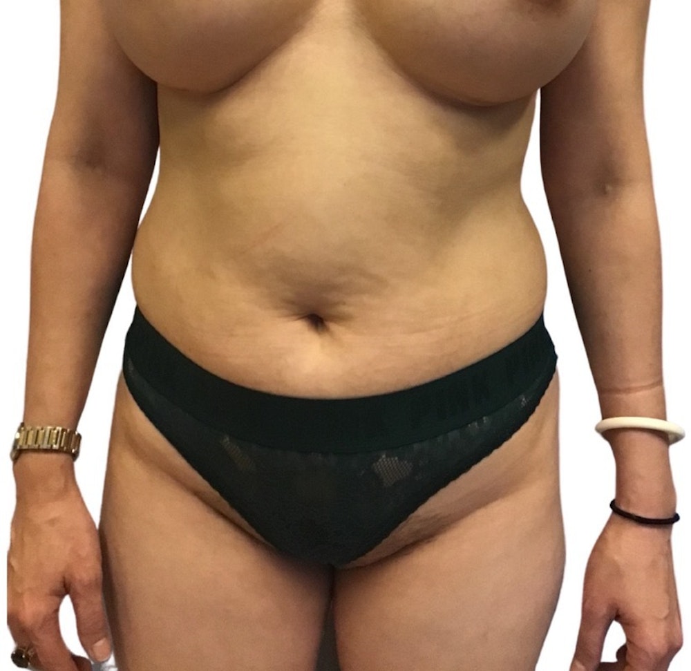 Abdominoplasty Before & After Gallery - Patient 13948280 - Image 1