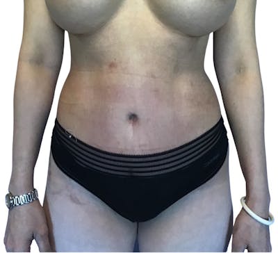 Abdominoplasty Before & After Gallery - Patient 13948280 - Image 2