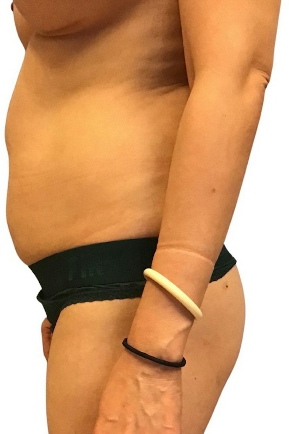 Abdominoplasty Before & After Gallery - Patient 13948280 - Image 3