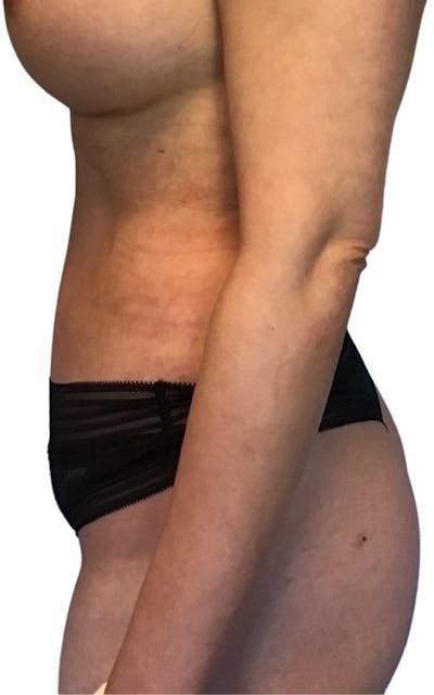 Abdominoplasty Before & After Gallery - Patient 13948280 - Image 4