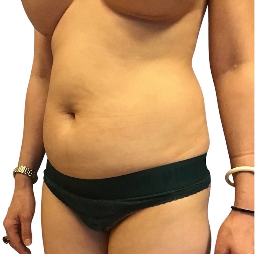 Abdominoplasty Before & After Gallery - Patient 13948280 - Image 5