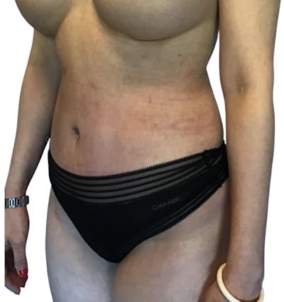 Abdominoplasty Before & After Gallery - Patient 13948280 - Image 6