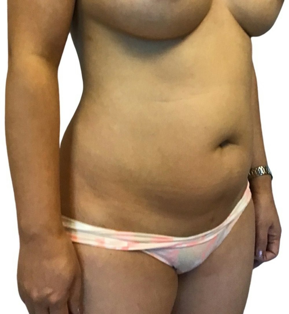 Abdominoplasty Before & After Gallery - Patient 13948281 - Image 1