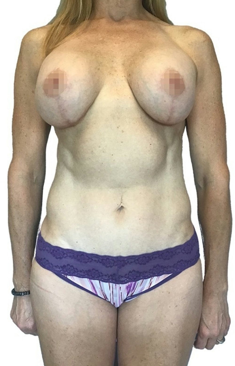 Abdominoplasty Before & After Gallery - Patient 13948282 - Image 2