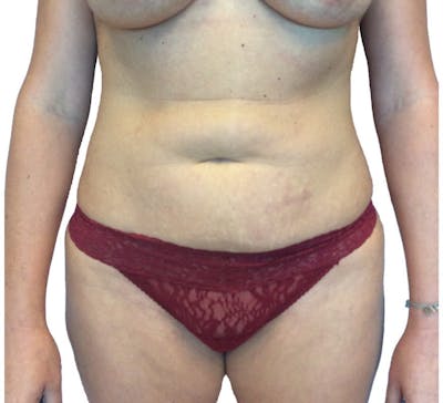 Abdominoplasty Before & After Gallery - Patient 13948283 - Image 1