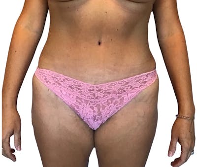 Abdominoplasty Before & After Gallery - Patient 13948283 - Image 2
