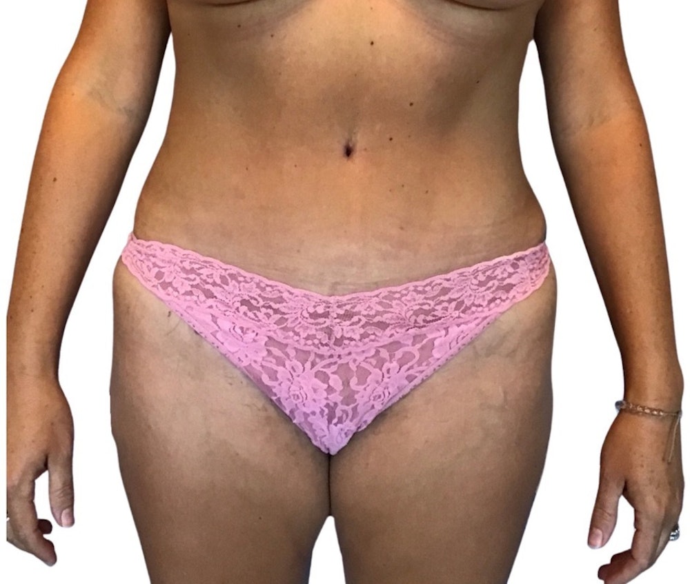 Abdominoplasty Before & After Gallery - Patient 13948283 - Image 2