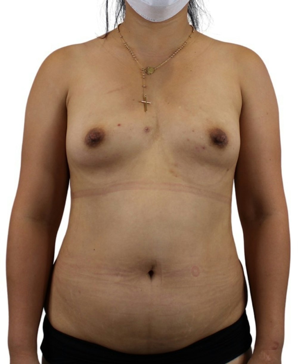 Liposuction Before & After Gallery - Patient 13948284 - Image 3