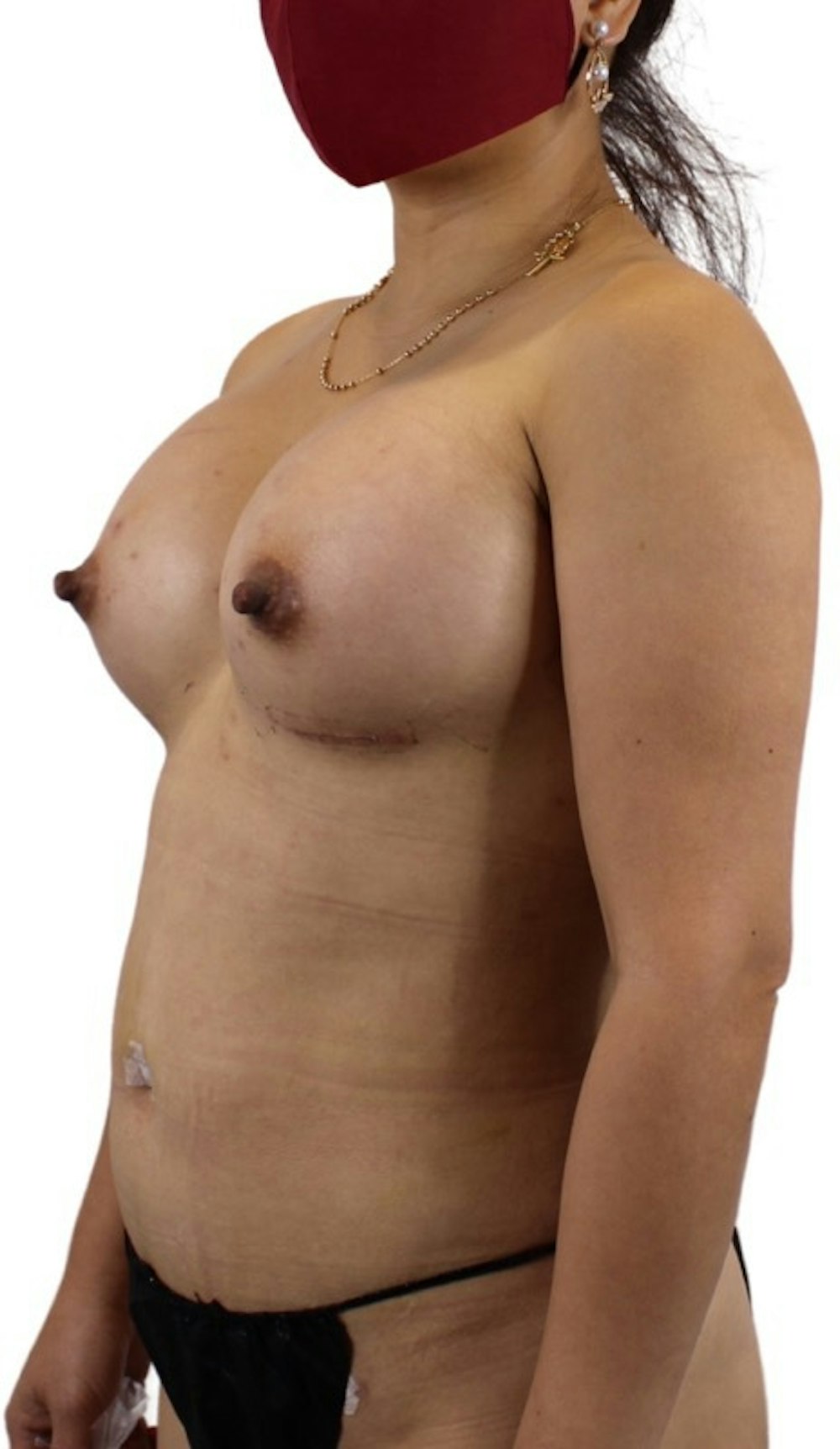 Liposuction Before & After Gallery - Patient 13948284 - Image 6