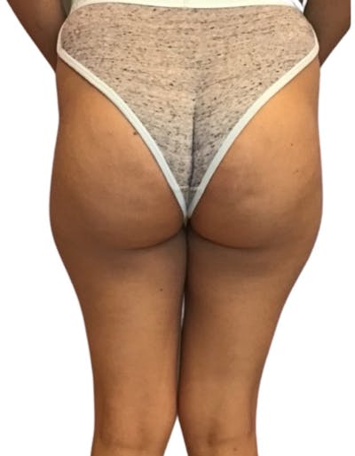 Brazilian Butt Lift Before & After Gallery - Patient 13948288 - Image 1