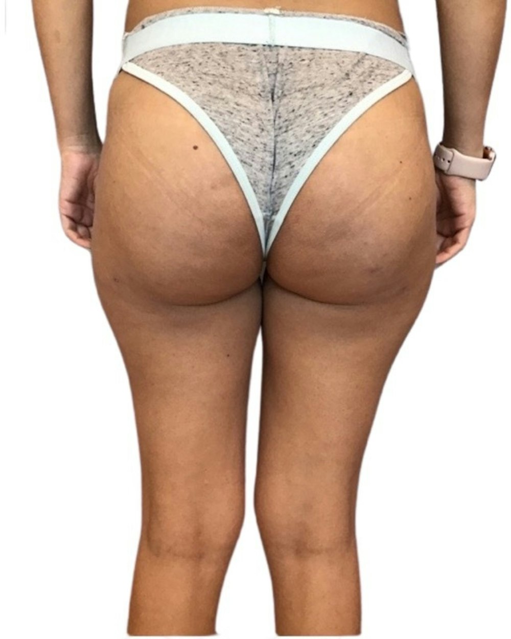 Brazilian Butt Lift Before & After Gallery - Patient 13948288 - Image 2