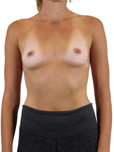Breast Augmentation Before & After Gallery - Patient 13948295 - Image 1