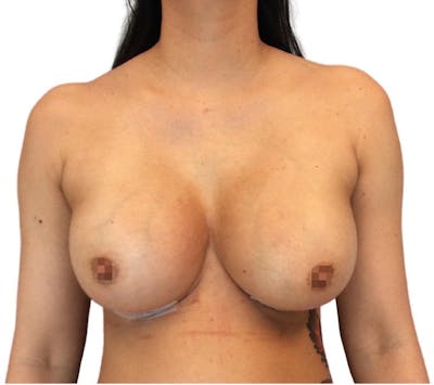 Breast Augmentation Before & After Gallery - Patient 13948296 - Image 2