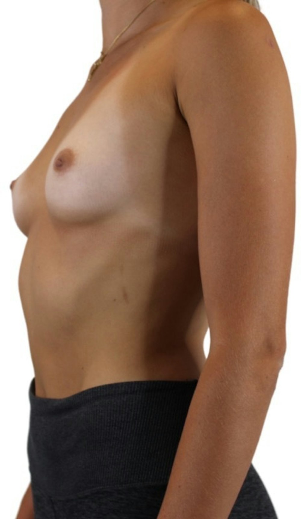 Breast Augmentation Gallery - Patient 13948295 - Image 5
