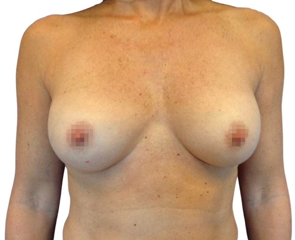 Breast Augmentation Before & After Gallery - Patient 13948297 - Image 1