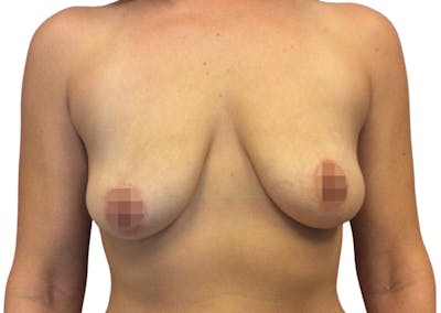 Breast Augmentation Before & After Gallery - Patient 13948298 - Image 1