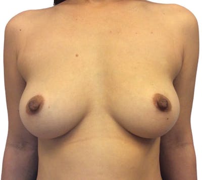 Breast Augmentation Before & After Gallery - Patient 13948299 - Image 1