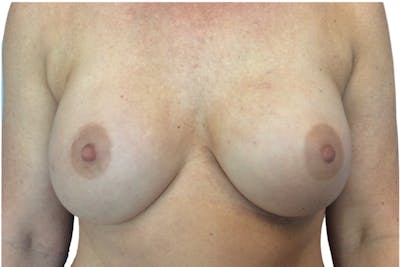 Breast Augmentation Before & After Gallery - Patient 13948300 - Image 1